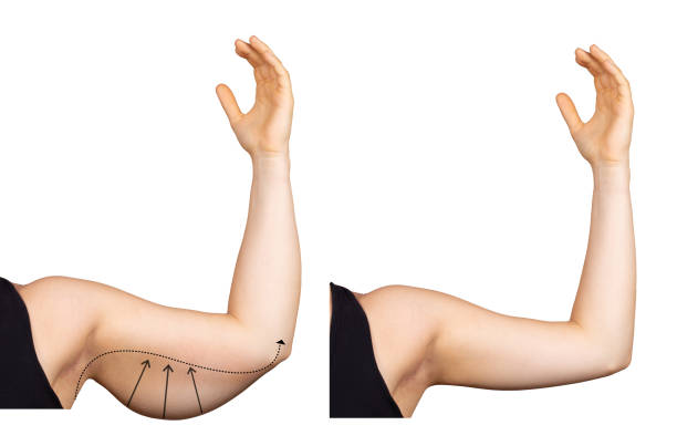 arm liposuction