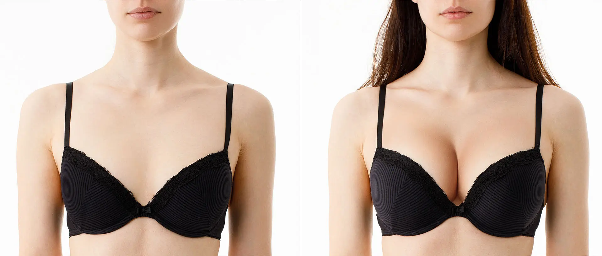 breast augmentation vs fat transfer