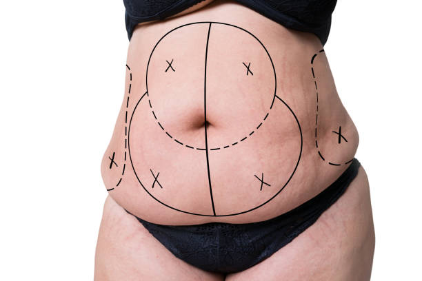 liposuction perut