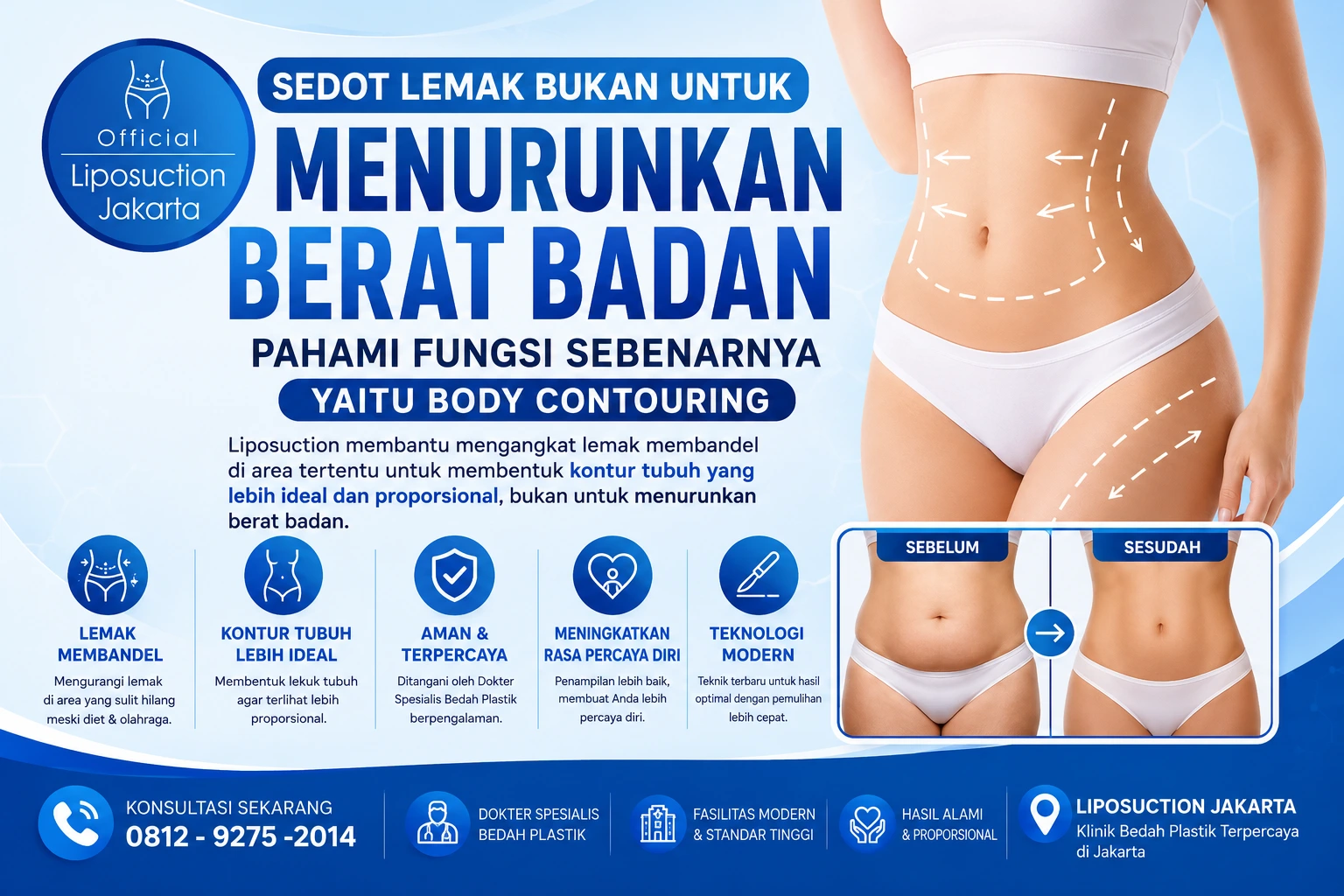 Ilustrasi prosedur sedot lemak (liposuction) untuk body contouring di Liposuction Jakarta